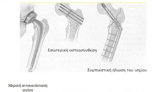 apokatastash isxiou