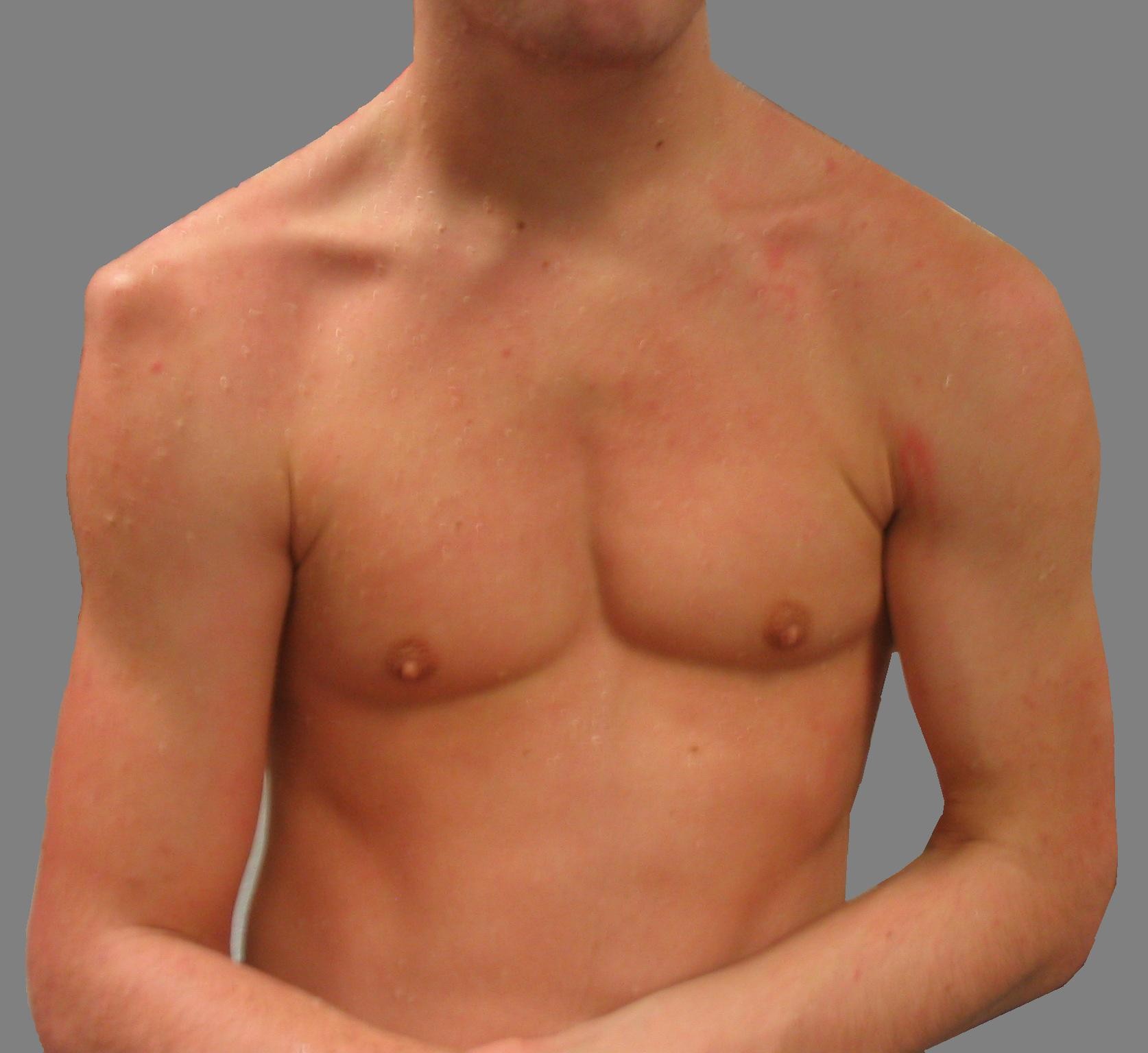 Вывих плечевого сустава симптомы у взрослых фото
